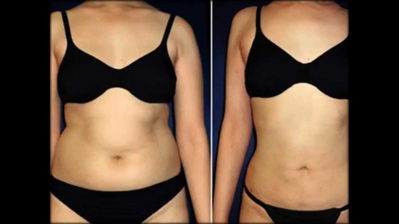 Жир на боках у женщин до и после